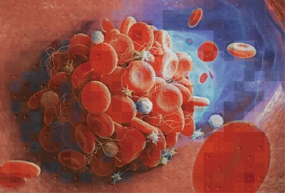 Major Review Finds Cancer Can Trigger Blood Clots and Sharply Raise Stroke Risk Soon After Diagnosis