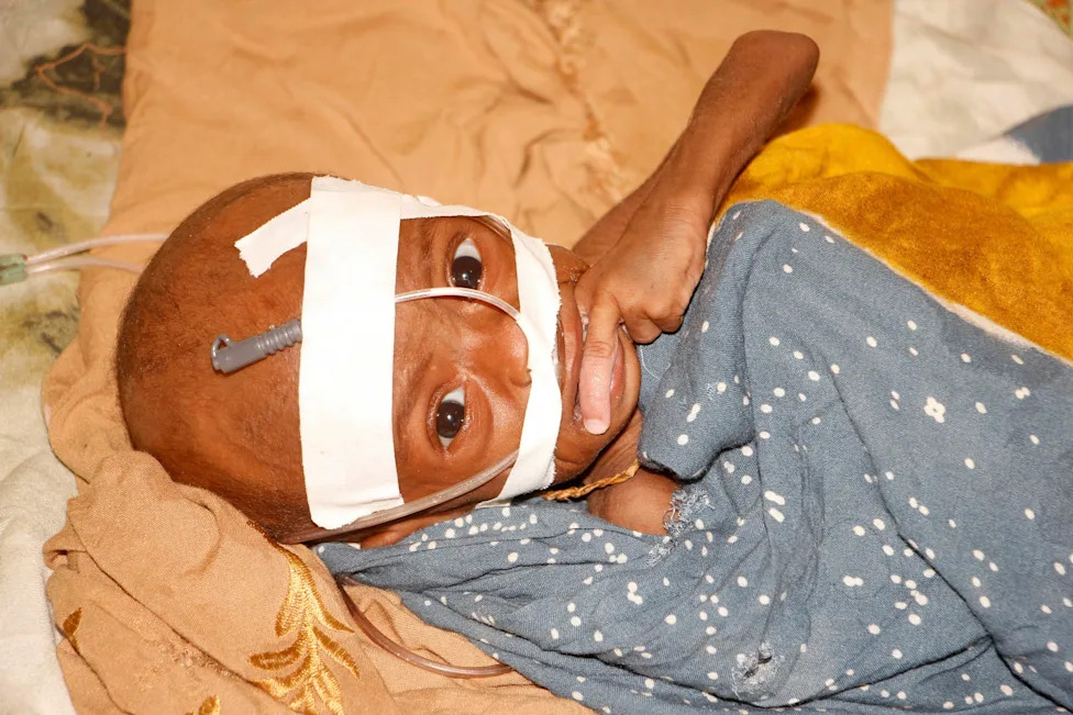 USAID’s Decline and the Human Cost: How U.S. Aid Cuts Are Linked to Hunger, Disease and Death