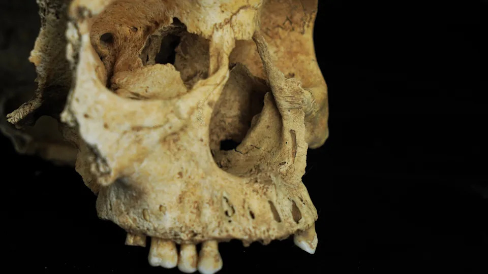 700-Year-Old Chinese Skull Provides First Skeletal Evidence Of Punitive Nose Amputation