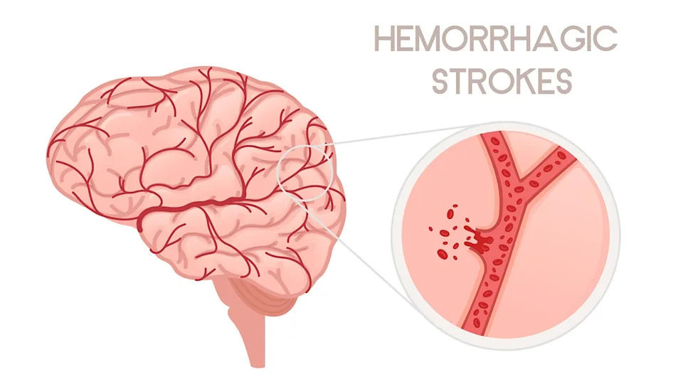 Study: First-Time Stroke Rates Nearly Double Among 20–54-Year-Olds Over Three Decades