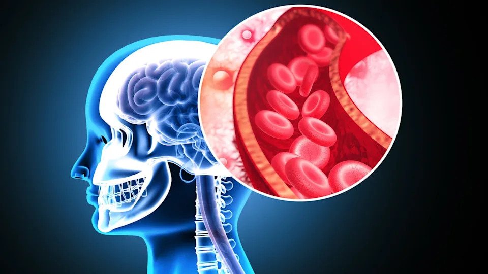 Study: First-Time Stroke Rates Nearly Double Among 20–54-Year-Olds Over Three Decades