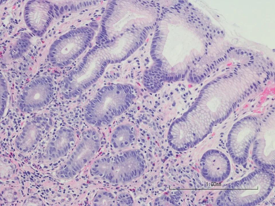 One in Eight Cancers Worldwide Linked to Common Infections, New IARC Review Finds