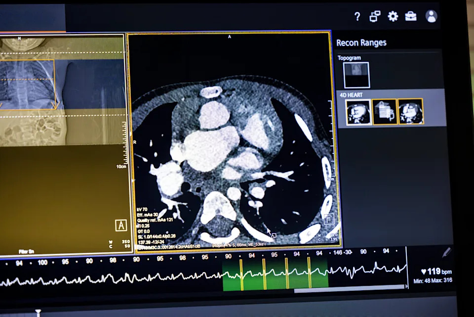 Four-Year-Old With Rare 'Criss-Cross' Heart Undergoes Life-Changing Surgery Planned With 3D-Printed Replica