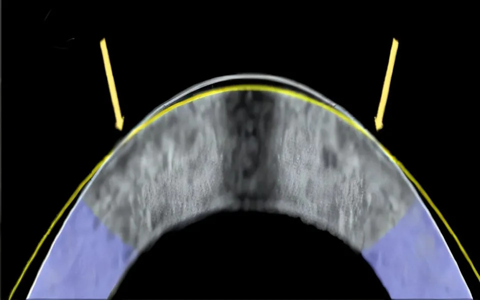 Scalpel- and Laser-Free Vision Correction? Electrical ‘Mold’ Reshapes Cornea in Lab Tests
