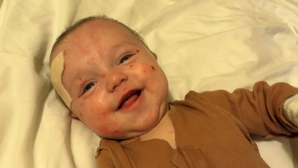 They Said My Baby's Skin Was 'Like Glass' — Family Urges More Research into 'Butterfly Skin' (JEB)