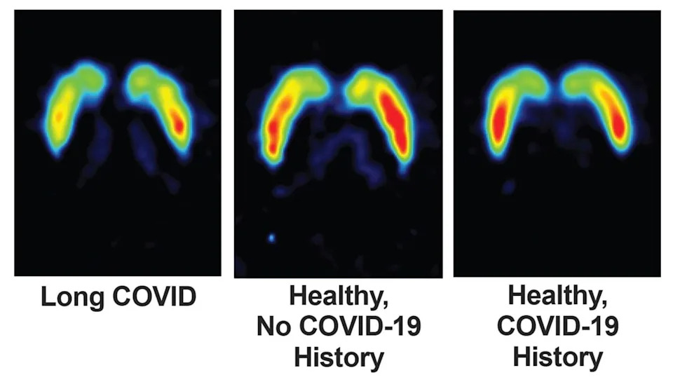 Brain Scans Suggest Dopamine Neuron Damage May Underlie Some Long COVID Symptoms