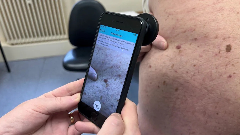 Bradford NHS Clinic Uses AI to Spot Skin Cancer Sooner, Cutting Waits and Unnecessary Biopsies